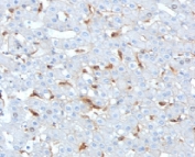 IHC staining of FFPE human hepatocellular carcinoma tissue with Complement C1q B-Chain antibody (clone C1QB/2962). HIER: boil tissue sections in pH 9 10mM Tris with 1mM EDTA for 20 min and allow to cool before testing.