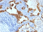 IHC staining of FFPE human lung carcinoma tissue with Cytokeratin 8/18 antibody (clone SPM192 + SPM265). HIER: boil tissue sections in pH 9 10mM Tris with 1mM EDTA for 20 min and allow to cool before testing.