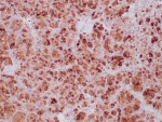 IHC staining of FFPE human paraganglioma tissue with recombinant SDHB antibody (clone SDHB/6697R). HIER: boil tissue sections in pH 9 10mM Tris with 1mM EDTA for 20 min and allow to cool before testing.