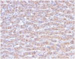 IHC staining of FFPE human liver carcinoma in colon tissue with CD40L antibody (clone CD40LG/4675) at 2ug/ml. HIER: boil tissue sections in pH 9 10mM Tris with 1mM EDTA for 20 min and allow to cool before testing.