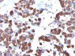 IHC staining of FFPE human thyroid tissue with TG antibody cocktail (clone TGB04 + TGB05). HIER: boil tissue sections in pH 9 10mM Tris with 1mM EDTA for 20 min and allow to cool before testing.