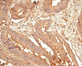 IHC staining of FFPE human colon tissue with Galectin 3 antibody (clone LGALS3/7036R). HIER: boil tissue sections in pH 9 10mM Tris with 1mM EDTA for 20 min and allow to cool before testing.~