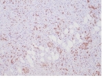 IHC staining of FFPE human anaplastic large cell lymphoma tissue with recombinant ALK antibody (clone ALK1/7008R). HIER: boil tissue sections in pH 9 10mM Tris with 1mM EDTA for 20 min and allow to cool before testing.