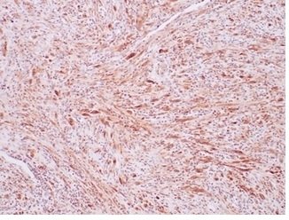 IHC staining of FFPE human inflammatory myofibroblastic tumor with recombinant ALK antibody (clone ALK1/7008R. HIER: boil tissue sections in pH 9 10mM Tris with 1mM EDTA for 20 min and allow to cool before testing.