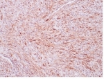 IHC staining of FFPE human inflammatory myofibroblastic tumor with ALK antibody (clone ALK1/7008R. HIER: boil tissue sections in pH 9 10mM Tris with 1mM EDTA for 20 min and allow to cool before testing.