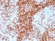 IHC staining of FFPE human thymus tissue with recombinant TdT antibody (clone DNTT/4617R). HIER: boil tissue sections in pH 9 10mM Tris with 1mM EDTA for 20 min and allow to cool before testing.