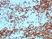 IHC staining of FFPE human thymoma tissue with recombinant TdT antibody (clone DNTT/4617R). HIER: boil tissue sections in pH 9 10mM Tris with 1mM EDTA for 20 min and allow to cool before testing.