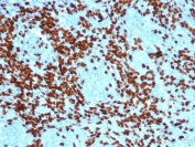 IHC staining of FFPE human thymoma with recombinant TdT antibody (clone DNTT/4617R). HIER: boil tissue sections in pH 9 10mM Tris with 1mM EDTA for 20 min and allow to cool before testing.