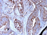 IHC staining of FFPE human colon carcinoma tissue with MERTK antibody (clone MERTK/3024). HIER: boil tissue sections in pH 9 10mM Tris with 1mM EDTA for 20 min and allow to cool before testing.