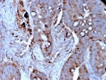 IHC staining of FFPE human colon carcinoma tissue with MERTK antibody (clone MERTK/3024). HIER: boil tissue sections in pH 9 10mM Tris with 1mM EDTA for 20 min and allow to cool before testing.