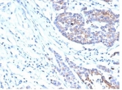 IHC staining of FFPE human colon carcinoma tissue with IGF1R antibody (clone IGF1R/4667). HIER: boil tissue sections in pH 9 10mM Tris with 1mM EDTA for 20 min and allow to cool before testing.
