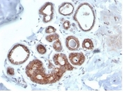 IHC staining of FFPE human breast carcinoma tissue with IGF1R antibody (clone IGF1R/4667). HIER: boil tissue sections in pH 9 10mM Tris with 1mM EDTA for 20 min and allow to cool before testing.