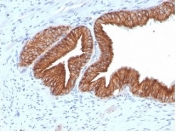 IHC staining of FFPE human prostate carcinoma tissue with IGF1R antibody (clone IGF1R/4667). HIER: boil tissue sections in pH 9 10mM Tris with 1mM EDTA for 20 min and allow to cool before testing.