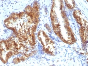 IHC staining of FFPE human prostate carcinoma tissue with AMACR antibody. HIER: boil tissue sections in pH 9 10mM Tris with 1mM EDTA for 20 min and allow to cool before testing.