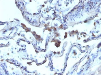 IHC staining of FFPE human lung carcinoma tissue with AMACR antibody. HIER: boil tissue sections in pH 9 10mM Tris with 1mM EDTA for 20 min and allow to cool before testing.
