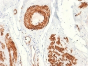 IHC staining of FFPE human leiomyosarcoma tissue with recombinant Caldesmon antibody (clone rCALD1/820). HIER: boil tissue sections in pH 9 10mM Tris with 1mM EDTA for 20 min and allow to cool before testing.