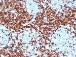 IHC staining of FFPE human thymus with DNA nucleotidylexotransferase antibody (clone DNTT/4506R). HIER: boil tissue sections in pH 9 10mM Tris with 1mM EDTA for 20 min and allow to cool before testing.