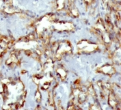 IHC staining of FFPE human angiosarcoma with CD31 antibody (clone C31.3 + JC/70A). HIER: boil tissue sections in pH 9 10mM Tris with 1mM EDTA for 20 min and allow to cool before testing.