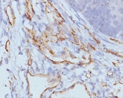 IHC staining of FFPE human colon carcinoma tissue with CD31 antibody (clone C31.3 + JC/70A). HIER: boil tissue sections in pH 9 10mM Tris with 1mM EDTA for 20 min and allow to cool before testing.