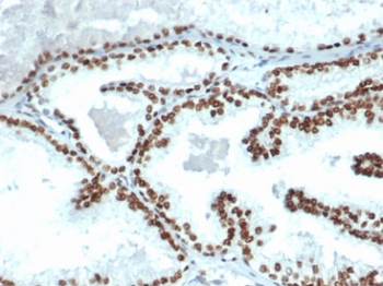 IHC staining of FFPE human prostate carcinoma tissue with recombinant Androgen Receptor antibody (clone clone DHTR/4445R). HIER: boil tissue sections in pH 9 10mM Tris with 1mM EDTA for 20 min and allow to cool before testing.~