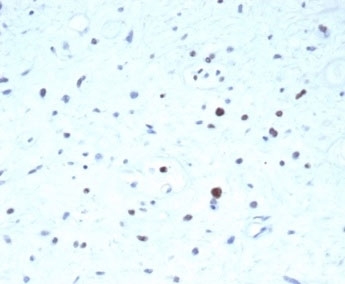 IHC staining of FFPE human rhabdomyosarcoma tissue with recombinant PAX7 antibody (clone PAX7/7079R). HIER: boil tissue sections in pH 9 10mM Tris with 1mM EDTA for 20 min and allow to cool before testing.~