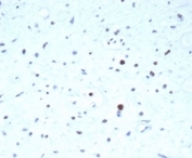 IHC staining of FFPE human rhabdomyosarcoma tissue with recombinant PAX7 antibody (clone PAX7/7079R). HIER: boil tissue sections in pH 9 10mM Tris with 1mM EDTA for 20 min and allow to cool before testing.