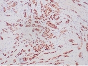 IHC staining of FFPE human breast carcinoma tissue with recombinant Progesterone Receptor antibody (clone PGR/6854R). HIER: boil tissue sections in pH 9 10mM Tris with 1mM EDTA for 20 min and allow to cool before testing.