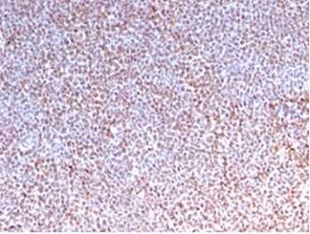 IHC staining of FFPE human anaplastic large cell lymphoma tissue with recombinant Anaplastic Lymphoma Kinase antibody (clone rALK1/1504). HIER: boil tissue sections in pH 9 10mM Tris with 1mM EDTA for 20 min and allow to cool before testing.~