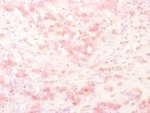 IHC staining of FFPE human melanoma tissue with Tyrosinase-Related Protein-1 antibody using AEC Chromogen (red). HIER: boil tissue sections in pH 9 10mM Tris with 1mM EDTA for 20 min and allow to cool before testing.