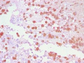 IHC staining of FFPE human melanoma tissue with Tyrosinase-Related Protein-1 antibody using AEC Chromogen (red). HIER: boil tissue sections in pH 9 10mM Tris with 1mM EDTA for 20 min and allow to cool before testing.~