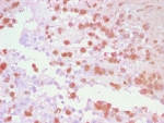 IHC staining of FFPE human melanoma tissue with Tyrosinase-Related Protein-1 antibody using AEC Chromogen (red). HIER: boil tissue sections in pH 9 10mM Tris with 1mM EDTA for 20 min and allow to cool before testing.