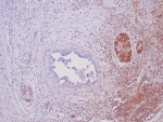 Immunohistochemical staining with recombinant SMAD4 antibody (clone SMAD4/6309R) showing loss of SMAD4 expression in pancreatic ductal adenocarcinoma and positive/retained SMAD4 staining in adjacent benign ductal epithelium and background stroma.
