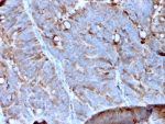 IHC staining of FFPE human colon carcinoma tissue with MERTK antibody (clone MERTK/3023). HIER: boil tissue sections in pH 9 10mM Tris with 1mM EDTA for 20 min and allow to cool before testing.