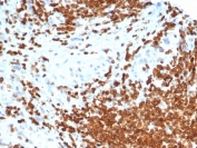 IHC staining of FFPE human bladder carcinoma tissue with Muellerian Inhibiting Factor antibody (clone AMH/6713R) at 2ug/ml in PBS for 30min RT. HIER: boil tissue sections in pH 9 10mM Tris with 1mM EDTA for 20 min and allow to cool before testing.