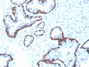 IHC staining of FFPE human prostate tissue with recombinant Cytokeratin 5 antibody (clone rKRT5/6398). HIER: boil tissue sections in pH 9 10mM Tris with 1mM EDTA for 20 min and allow to cool before testing.