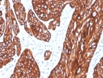 IHC staining of FFPE human squamous cell carcinoma tissue with recombinant Cytokeratin 5 antibody (clone rKRT5/6398). HIER: boil tissue sections in pH 9 10mM Tris with 1mM EDTA for 20 min and allow to cool before testing.