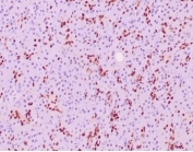 IHC staining of FFPE human pancreatic tissue with SOX9 antibody (clone SOX9/2387) at 2ug/ml. HIER: boil tissue sections in pH 9 10mM Tris with 1mM EDTA for 20 min and allow to cool before testing.