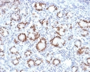 IHC staining of FFPE human gastric carcinoma tissue with SOX9 antibody (clone SOX9/2387) at 2ug/ml. HIER: boil tissue sections in pH 9 10mM Tris with 1mM EDTA for 20 min and allow to cool before testing.