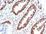 IHC staining of FFPE human ovarian carcinoma tissue with recombinant Wilms Tumor 1 antibody (clone WT1/3477R). Negative control inset: PBS instead of primary antibody to control for secondary binding. HIER: boil tissue sections in pH 9 10mM Tris with 1mM EDTA for 20 min and allow to cool before testing.