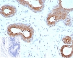 IHC staining of FFPE human breast carcinoma tissue with recombinant BAP1 antibody (clone BAP1/6861R). Negative control inset: PBS instead of primary antibody to control for secondary binding. HIER: boil tissue sections in pH 9 10mM Tris with 1mM EDTA for 20 min and allow to cool before testing.