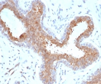 IHC staining of FFPE human breast carcinoma tissue with recombinant BAP1 antibody (clone BAP1/6861R). HIER: boil tissue sections in pH 9 10mM Tris with 1mM EDTA for 20 min and allow to cool before testing.~