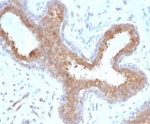 IHC staining of FFPE human breast carcinoma tissue with recombinant BAP1 antibody (clone BAP1/6861R). HIER: boil tissue sections in pH 9 10mM Tris with 1mM EDTA for 20 min and allow to cool before testing.