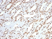 IHC staining of FFPE human colon carcinoma tissue with XRCC5/Ku80 antibody (clone XRCC5/7315). HIER: boil tissue sections in pH 9 10mM Tris with 1mM EDTA for 20 min and allow to cool before testing.