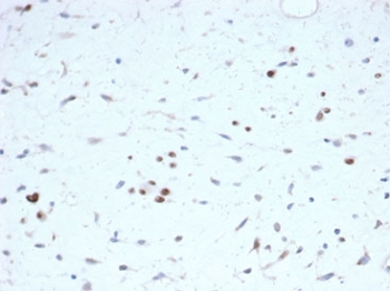 IHC staining of FFPE human rhabdomyosarcoma tissue with recombinant MyoD1 antibody (clone rMYOD1/6911) at 2ug/ml. HIER: boil tissue sections in pH 9 10mM Tris with 1mM EDTA for 20 min and allow to cool before testing.~
