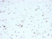 IHC staining of FFPE human rhabdomyosarcoma tissue with recombinant MyoD1 antibody (clone rMYOD1/6911) at 2ug/ml. HIER: boil tissue sections in pH 9 10mM Tris with 1mM EDTA for 20 min and allow to cool before testing.