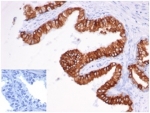 IHC staining of FFPE human prostate carcinoma with recombinant EpCAM antibody (clone rEGP40/826). Negative control inset: PBS instead of primary antibody to control for secondary binding. HIER: boil tissue sections in pH 9 10mM Tris with 1mM EDTA for 20 min and allow to cool before testing.