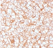 IHC staining of FFPE human liver tissue with APOB antibody (clone APOB/4332). HIER: boil tissue sections in pH 9 10mM Tris with 1mM EDTA for 20 min and allow to cool before testing.