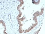 IHC staining of FFPE human prostate carcinoma tissue with recombinant Beta Catenin antibody (clone CTNNB1/7044R). HIER: boil tissue sections in pH 9 10mM Tris with 1mM EDTA for 20 min and allow to cool before testing.
