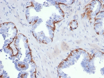 IHC staining of FFPE human prostate carcinoma tissue with recombinant Keratin 5 antibody (clone KRT5/6399R). HIER: boil tissue sections in pH 9 10mM Tris with 1mM EDTA for 20 min and allow to cool before testing.~