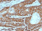 IHC staining of FFPE human cervical carcinoma tissue with recombinant RPSA antibody (clone rRPSA/6333). HIER: boil tissue sections in pH 9 10mM Tris with 1mM EDTA for 20 min and allow to cool before testing.